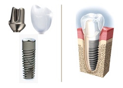 Impianto dentale, componentista implantare  e corona in zirconio